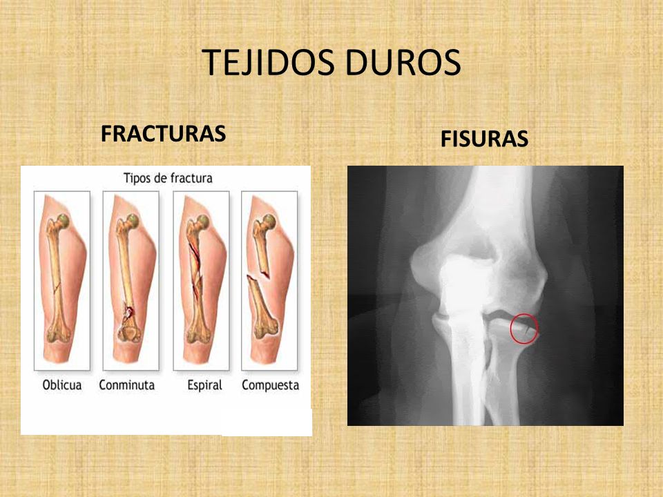 que disparidad feed linear unit una fractura y una fisura